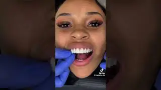 Watch the Magic of Veneers in 30 Seconds