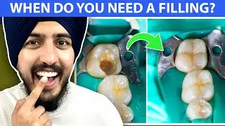 When Do You NEED A Dental Filling? Dentist Explains