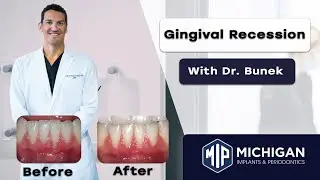What is Gingival Recession? With Dr. Julius Bunek at Michigan Implants and Periodontics