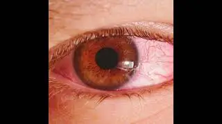 आई फ्लू से कैसे बचे ll eye flu se kaise bache #@chofindings5362 #medical #medico #nurse #eyehealth