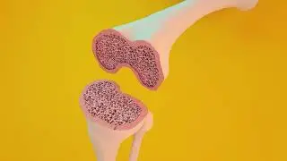 Knee Replacement Surgical Animation