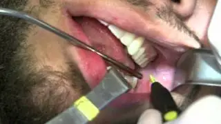 Buccal Fat Pad Reduction: The Real Deal by Dr. Joe Niamtu