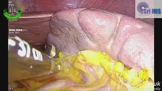 Laparoscopic Splenectomy (Educational Uncut)
