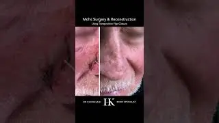 Mohs Reconstruction and Scar Revision of the Nose by Dr. Hooman Khorasani