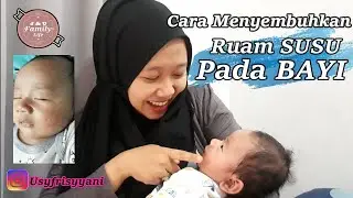 Cara menyembuhkan Ruam susu pada bayi