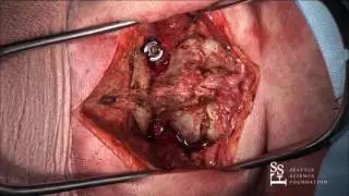 Bioskills Lab: Posterior C1, C2 Fixation - Bizhan Aarabi, M.D.