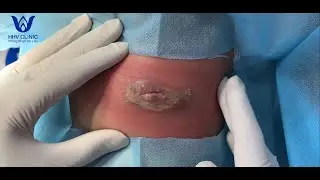 MỤN ÁP XE ĐAU NHỨC VÙNG ĐÙI
