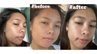 Pigmentation treatment