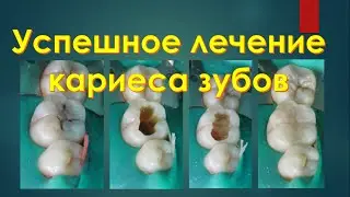 Секреты Стоматологии - Глава 2. Лечение Кариеса