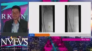 Rotarex Redefining Atherectomy & Thrombectomy Daniel K  Han