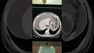 Cirrhosis of liver with Multiple splenorenal collaterals - Classic case