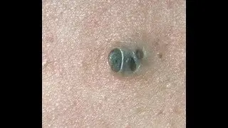 Выдавливание черных угрей