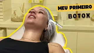FIZ MEU PRIMEIRO BOTOX - Doí? Qual valor? | MINHA EXPERIÊNCIA COMPLETA