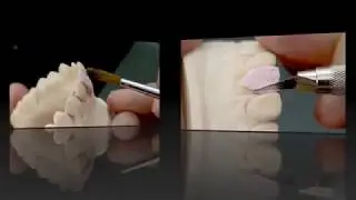 Основные этапы изготовления металлокерамической коронки