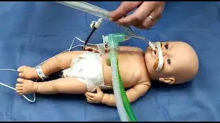 Sistema cerrado de aspiración endotraqueal