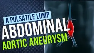 A Patient with a Pulsatile Lump - How to Approach an Abdominal Aortic Aneurysm - AAA