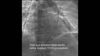 Minimally Invasive TAVI Device | Sunnybrook Health Sciences Centre