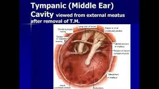 13:20-14:50 Лекция №4ММФТаня AOM  Mastoiditis