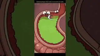 Leads to canceration of cardia
