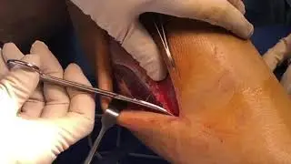 4 Compartment Fasciotomy for Chronic Compartment syndrome