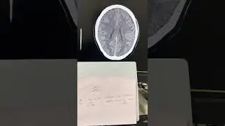 HU Scale demonstration NCCT BRAIN