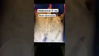 Abdominal X ray bowel obstruction