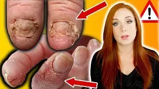 BREAKING NEWS - NAIL ALLERGIES, YOUR SERIOUS RISKS & HOW TO STOP THEM
