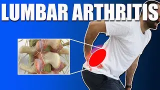 Lumbar Facet Syndrome: Causes, Symptoms, and Effective Treatments for Lower Back Pain