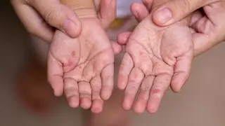 Hand, Foot and Mouth Disease - Akron Children's Hospital video