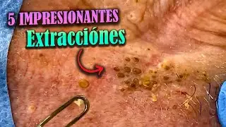 PUNTOS NEGROS Y COMEDONES: 5 VIDEOS IMPRESIONANTES SOBRE EXTRACCIÓN DE GRANOS ? 😱🔥
