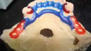 Prótese Dentária: escultura passo a passo de uma armação de PPR