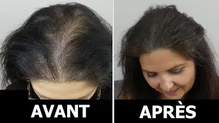Micropigmentation des Cheveux pour Femme