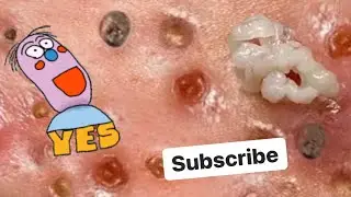 Top Ten Amateur Pops!  Acne Removal Demonstration
