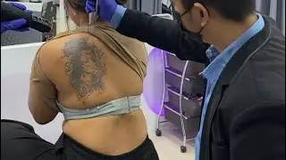 Laser Tatto Removal Full Body