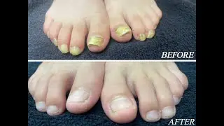 Laser Fungal Nail treatment in 8 year old boy. Part 2.