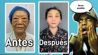 CIRUGIAS PLASTICAS EXTREMAS