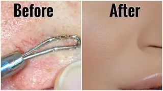HOW TO CLEAN CLOGGED PORES, WHITEHEADS & BLACKHEADS AT HOME &