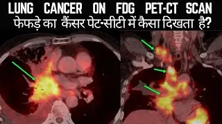फेफड़े का कैंसर Lung cancer #petctreportkaisedekhe #petctreportreading #fdg #lungcancer #petctscan