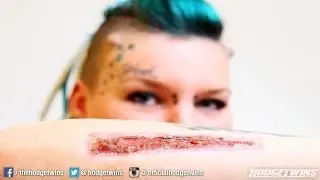 Tattoo Removal Fail @hodgetwins