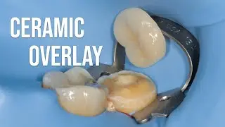 Ceramic overlay delivery
