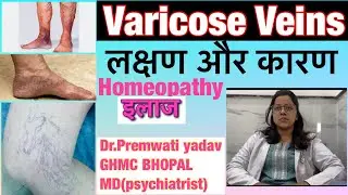 Varicose Veins! वेरिकोज़ वेन्स कारण, लक्षण और इलाज |high blood pressure #bloodpressure #homeopathy