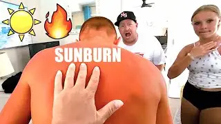 WHO GOT THE WORST SUNBURN? ☀️🔥