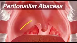 Peritonsillar Abscess - Identification and Treatment