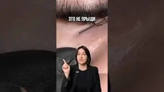 Как вылечить милиумы или просянку 👆 