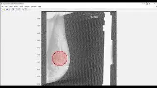 Breast Cancer Detection in Mammogram Images using Deep Learning