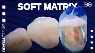 Using soft matrices in direct restorations
