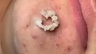 Disgustingly Satisfying Pimple, Blackhead Extraction. tiktok compilation #part2
