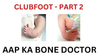 CLUBFOOT -  PART   2 - EPISODE 60