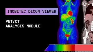 PET/CT analysis module of Inobitec DICOM Viewer Pro