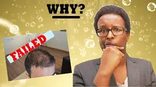 The 4 Reasons Hair Transplants FAIL [16 years of data]